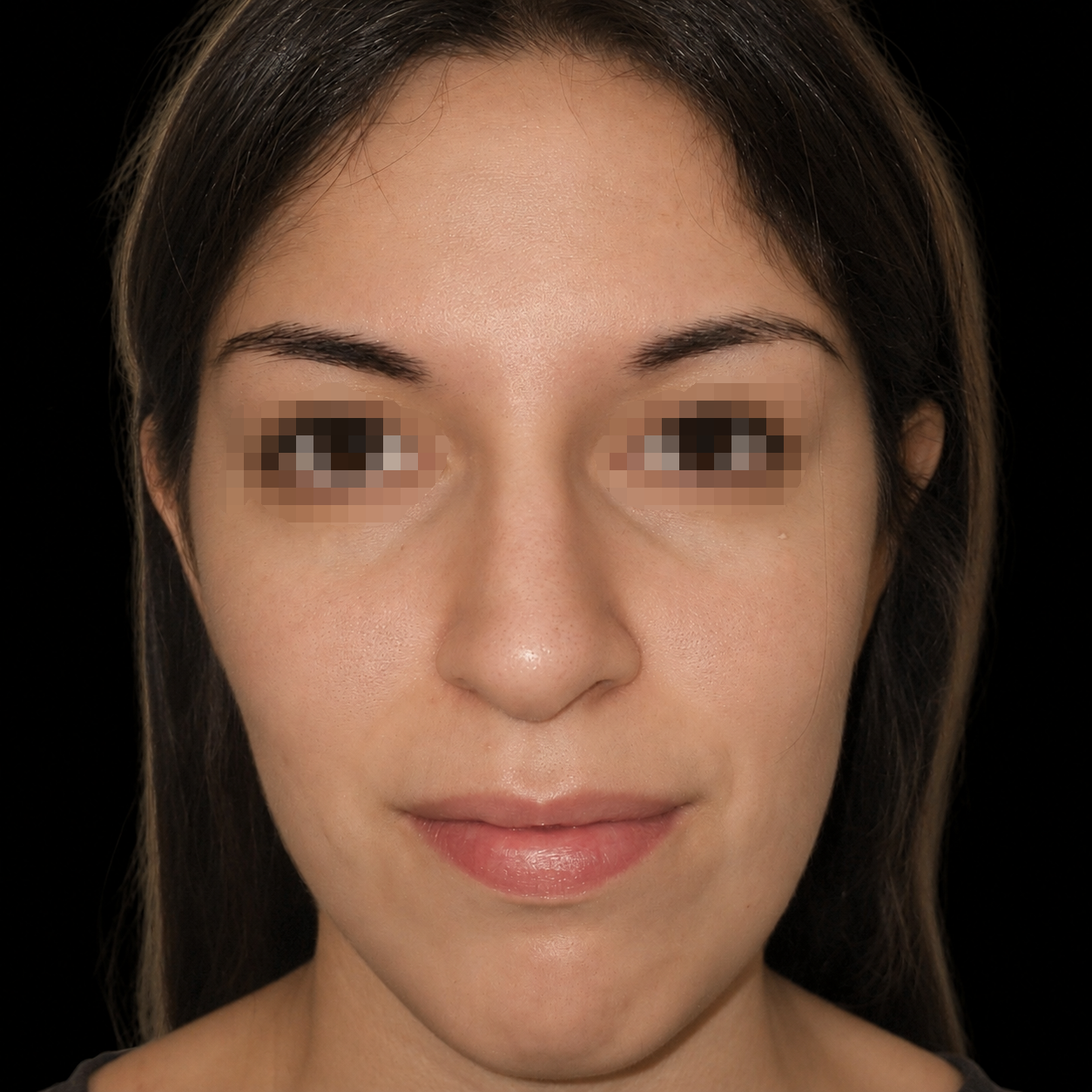 Rinoplastia antes - caso 1, vista frontal