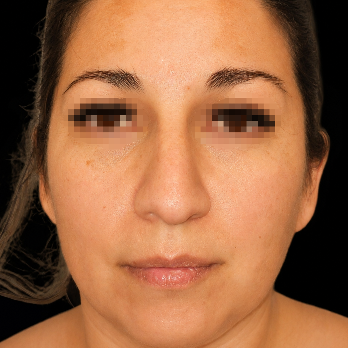 Rinoplastia antes - caso 2, vista frontal