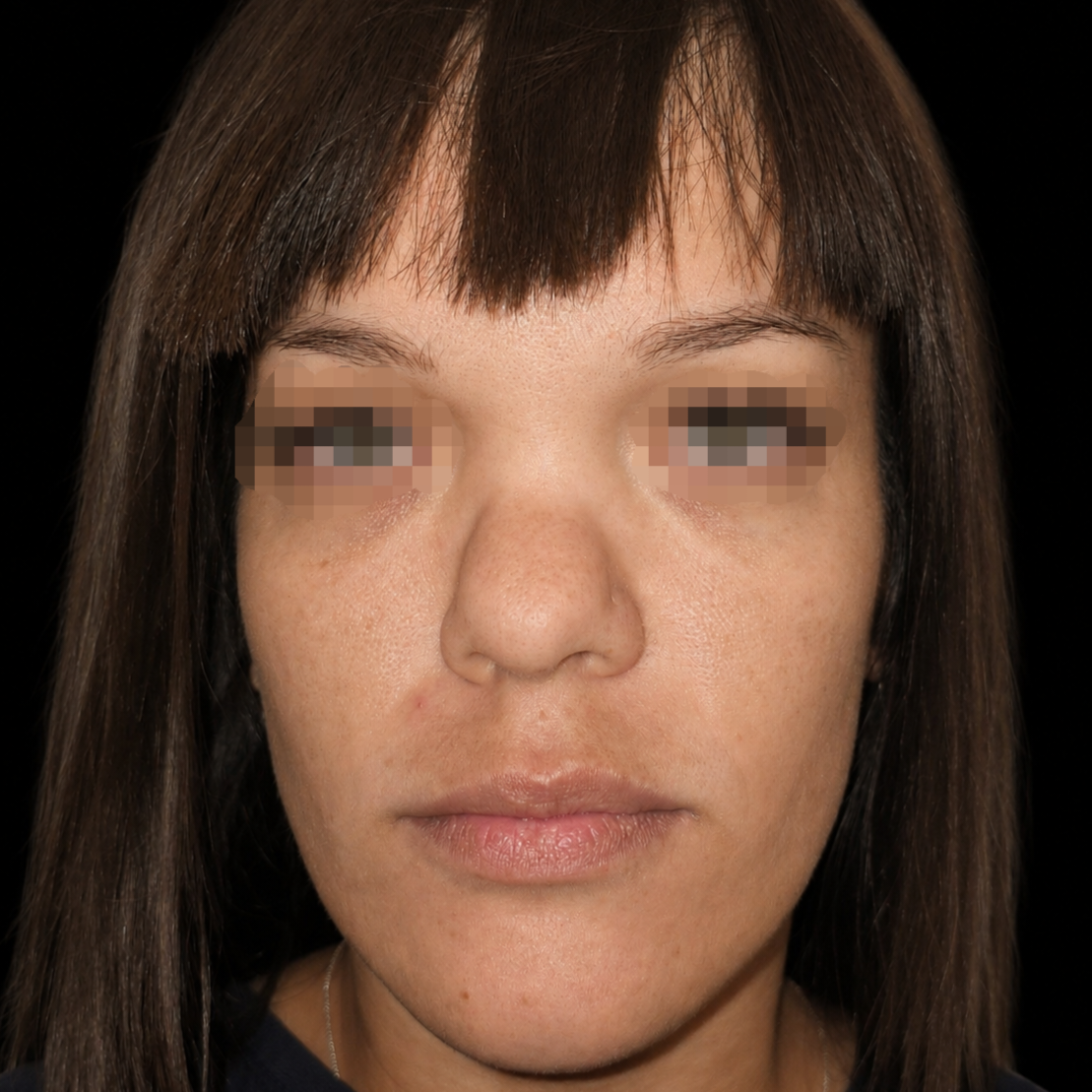 Rinoplastia antes - caso 3, vista frontal