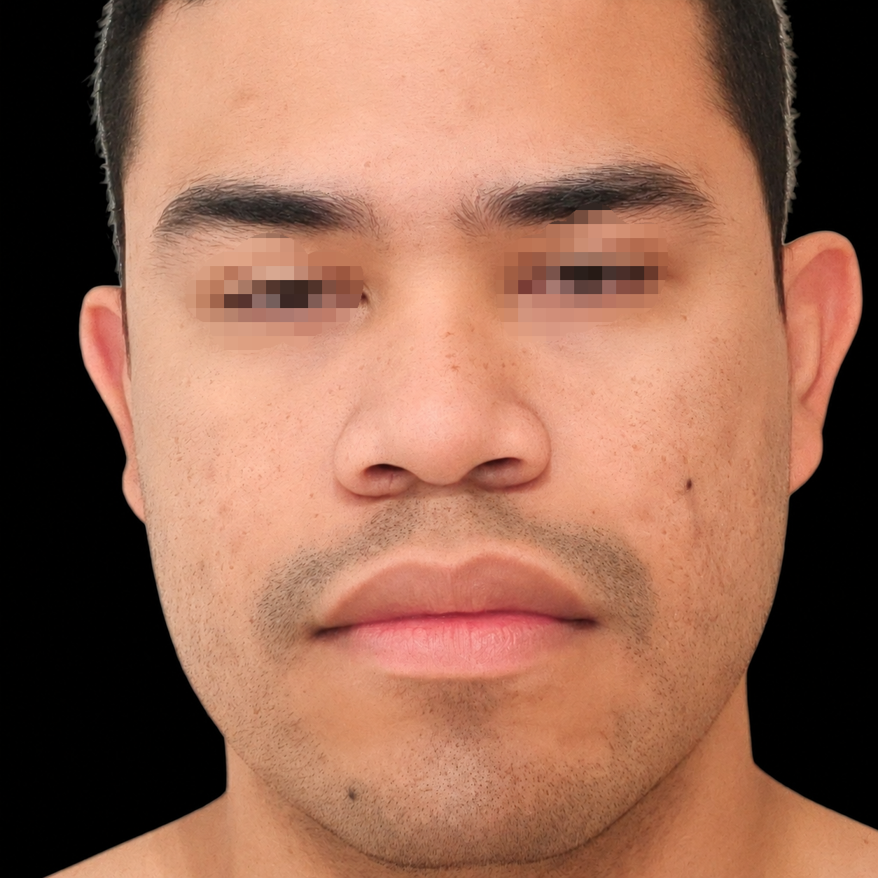 Rinoplastia antes - caso 4, vista frontal