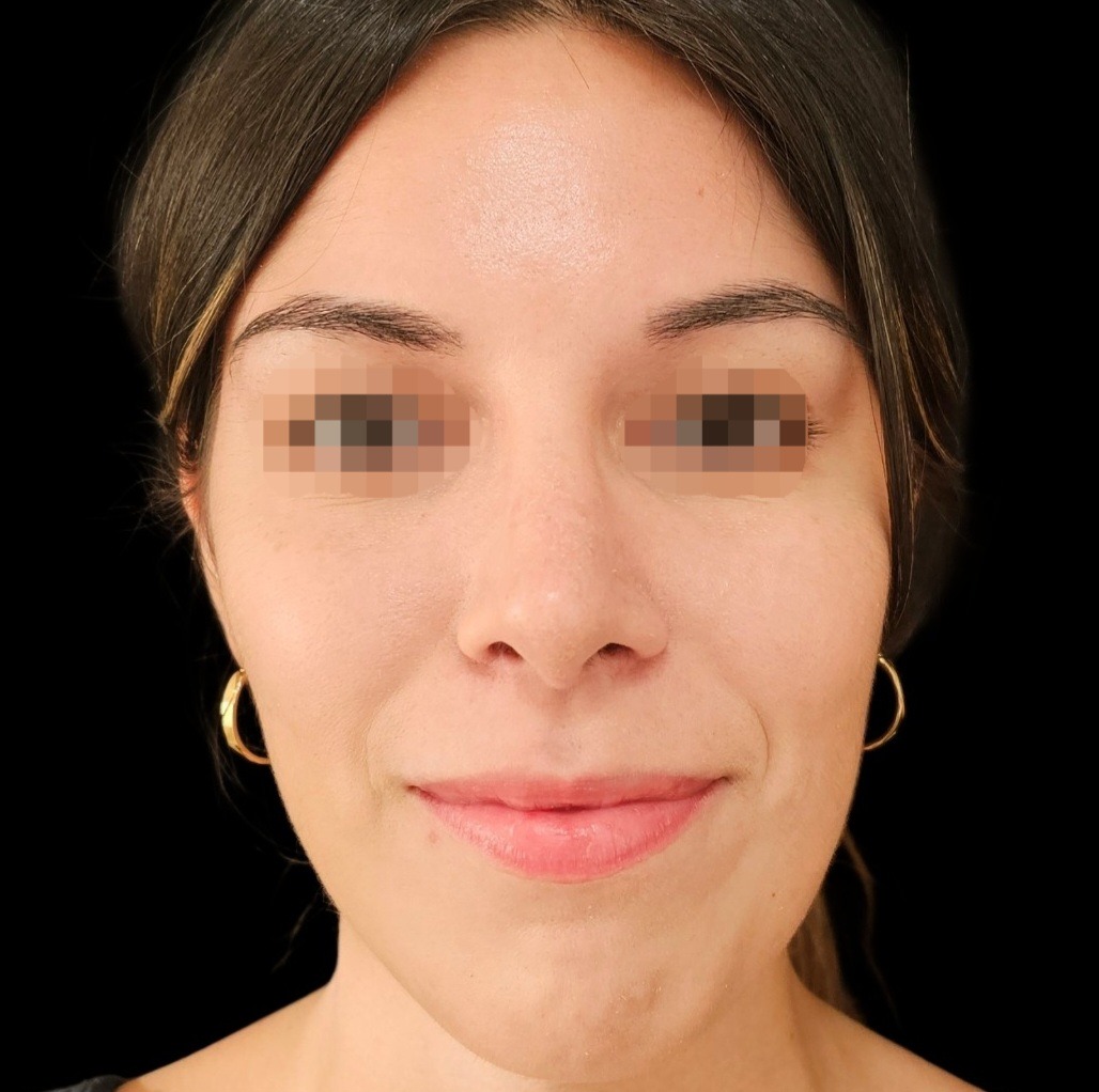 Resultado de rinoplastia realizada por el Dr. Gil Miranda en Buenos Aires