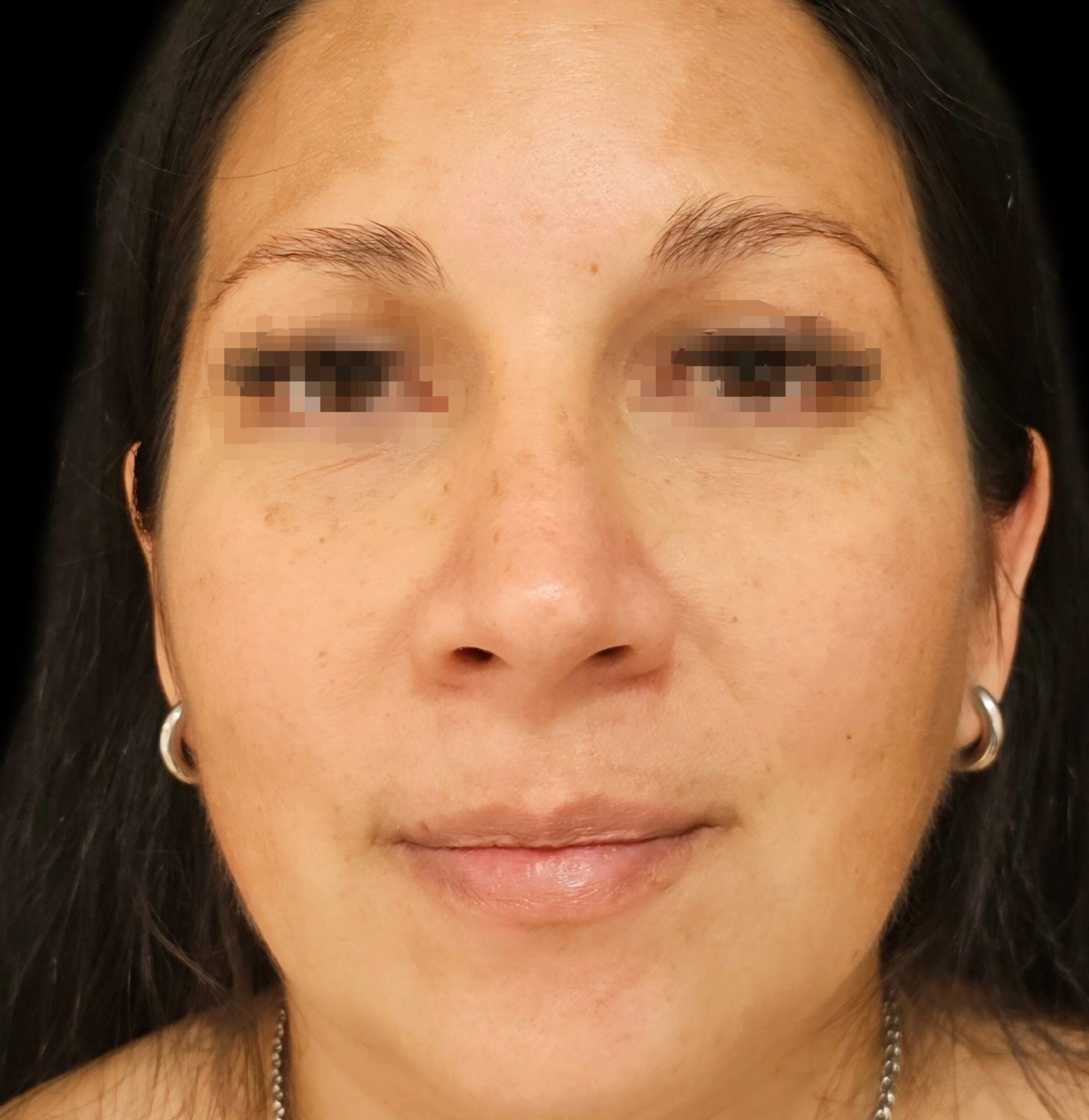 Rinoplastia después - caso 2, vista frontal