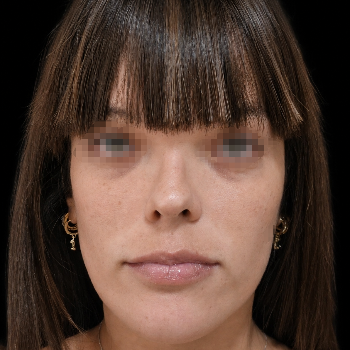 Rinoplastia después - caso 3, vista frontal