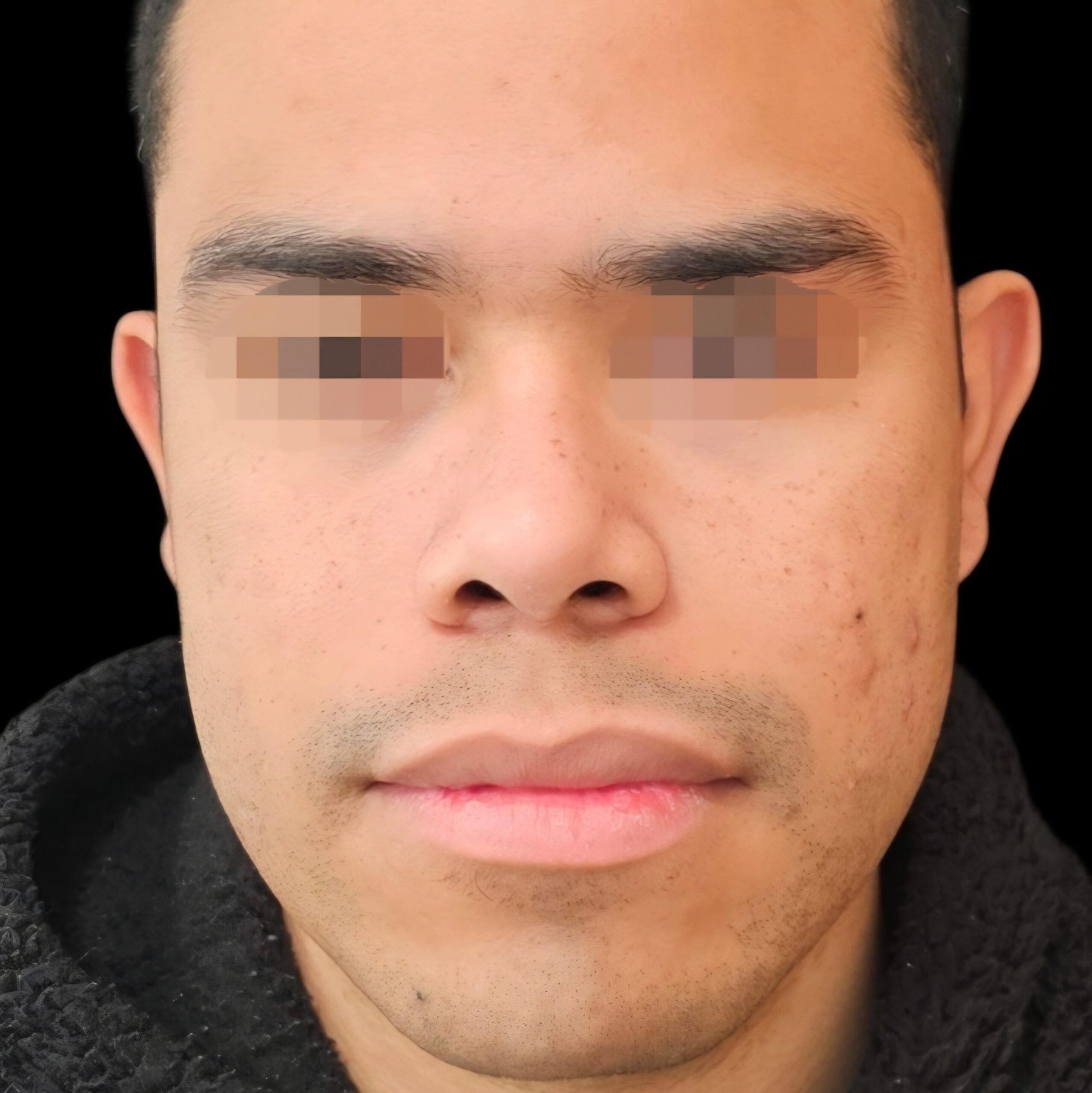 Rinoplastia después - caso 4, vista frontal