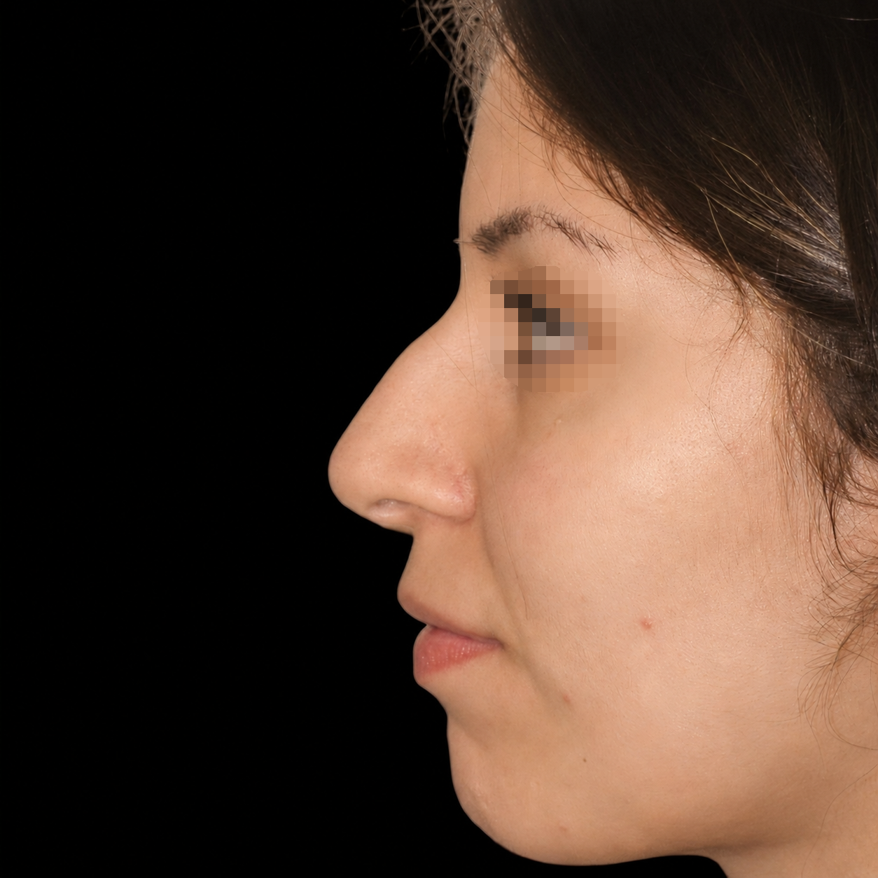 Rinoplastia antes - caso 1, vista de perfil