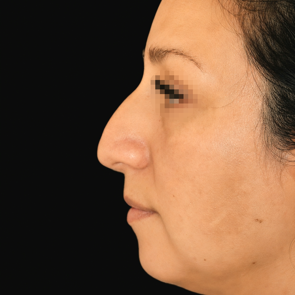 Rinoplastia antes - caso 2, vista de perfil