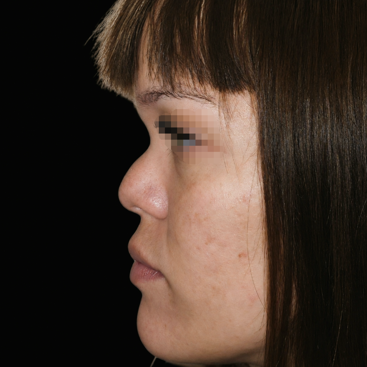 Rinoplastia antes - caso 3, vista de perfil