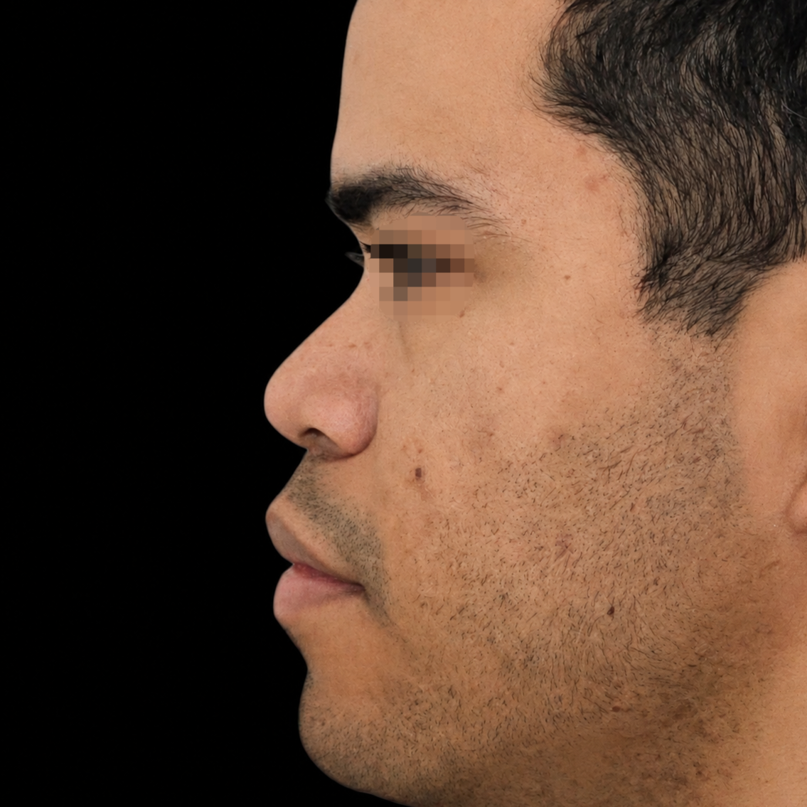Rinoplastia antes - caso 4, vista de perfil