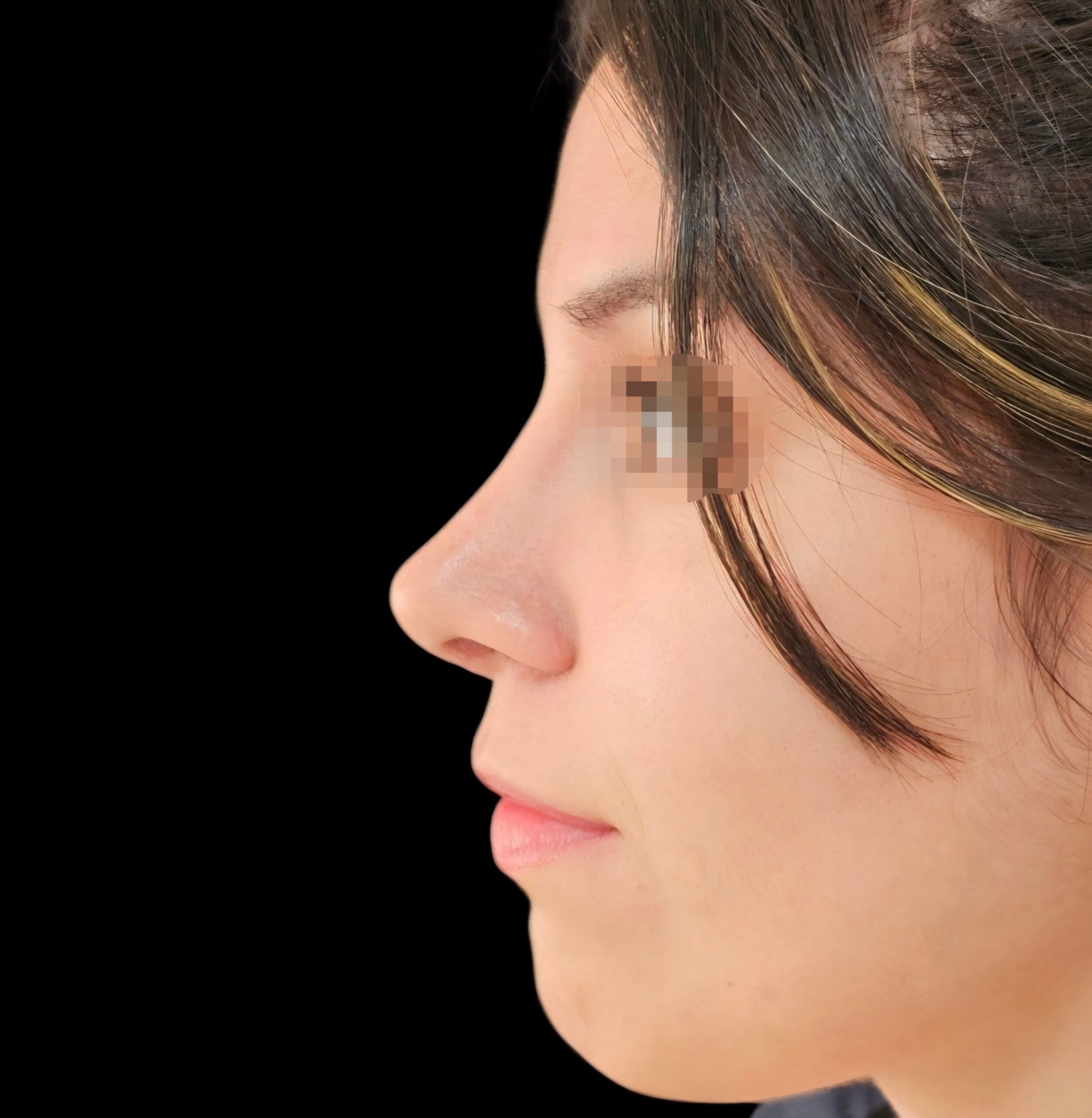 Rinoplastia después - caso 1, vista de perfil