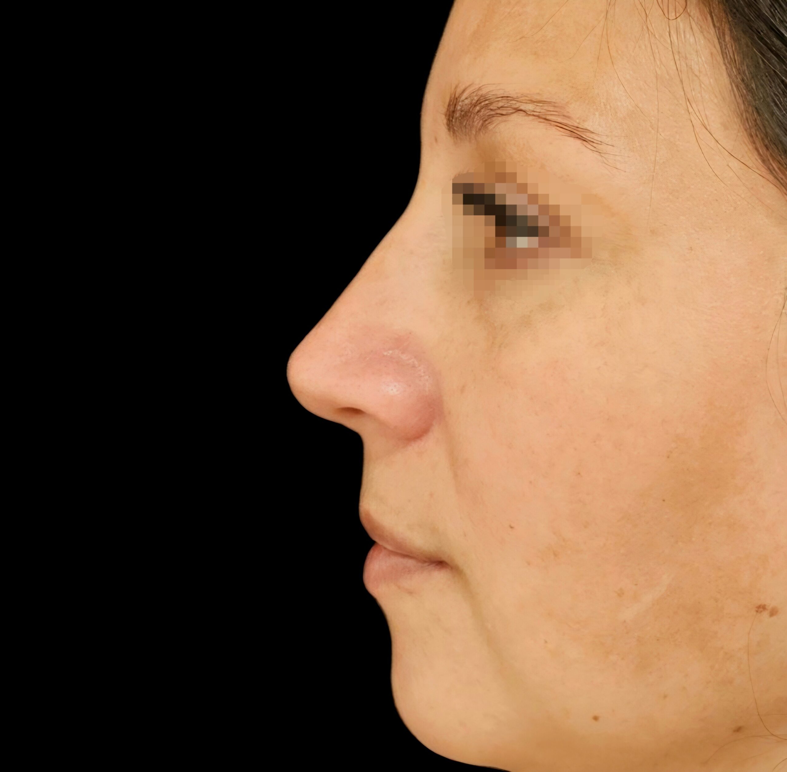 Rinoplastia después - caso 2, vista de perfil