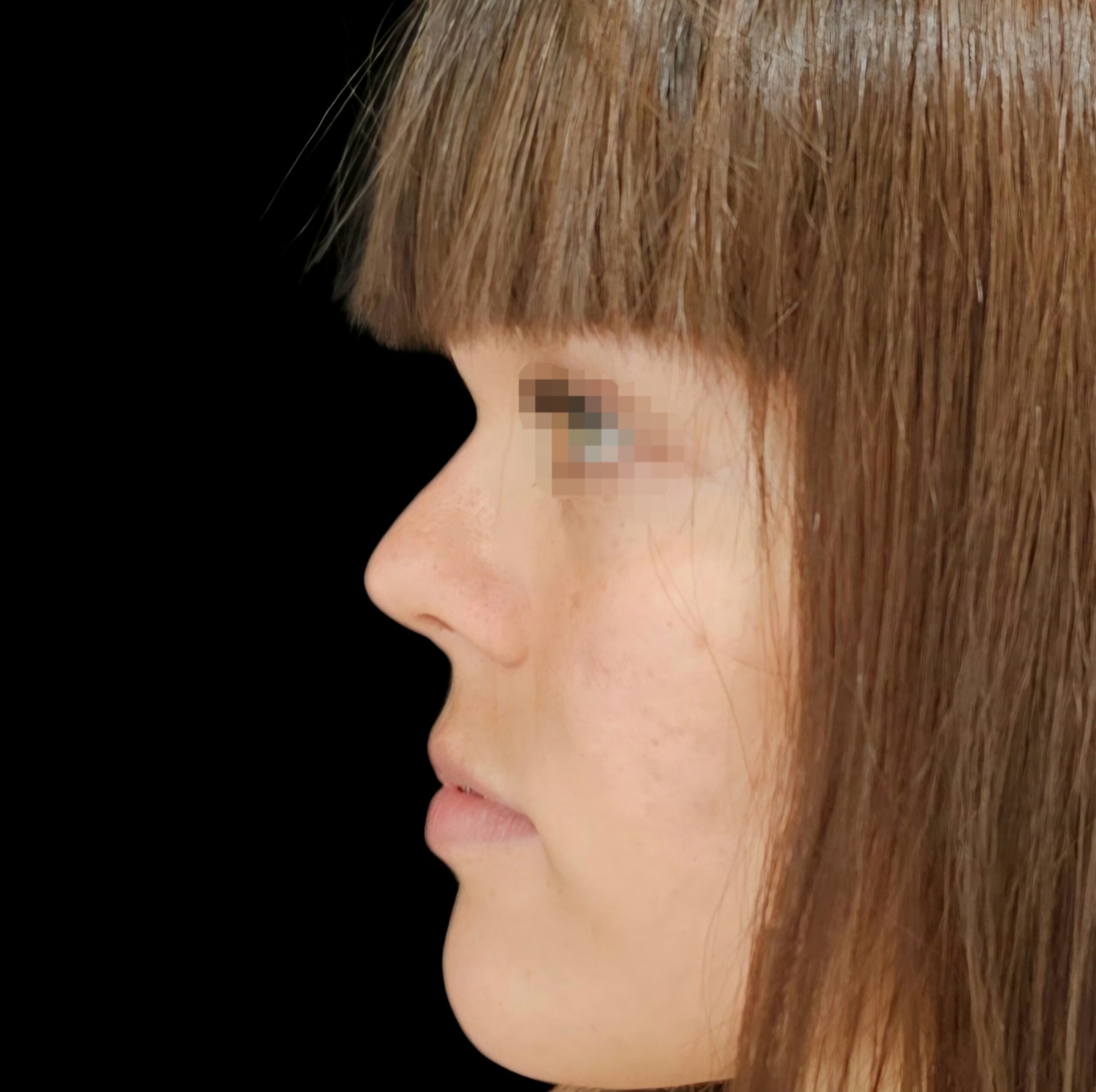 Rinoplastia después - caso 3, vista de perfil