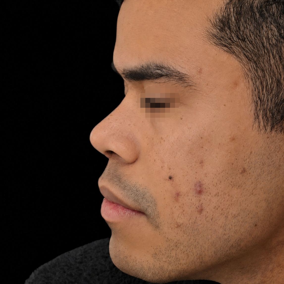Rinoplastia después - caso 4, vista de perfil