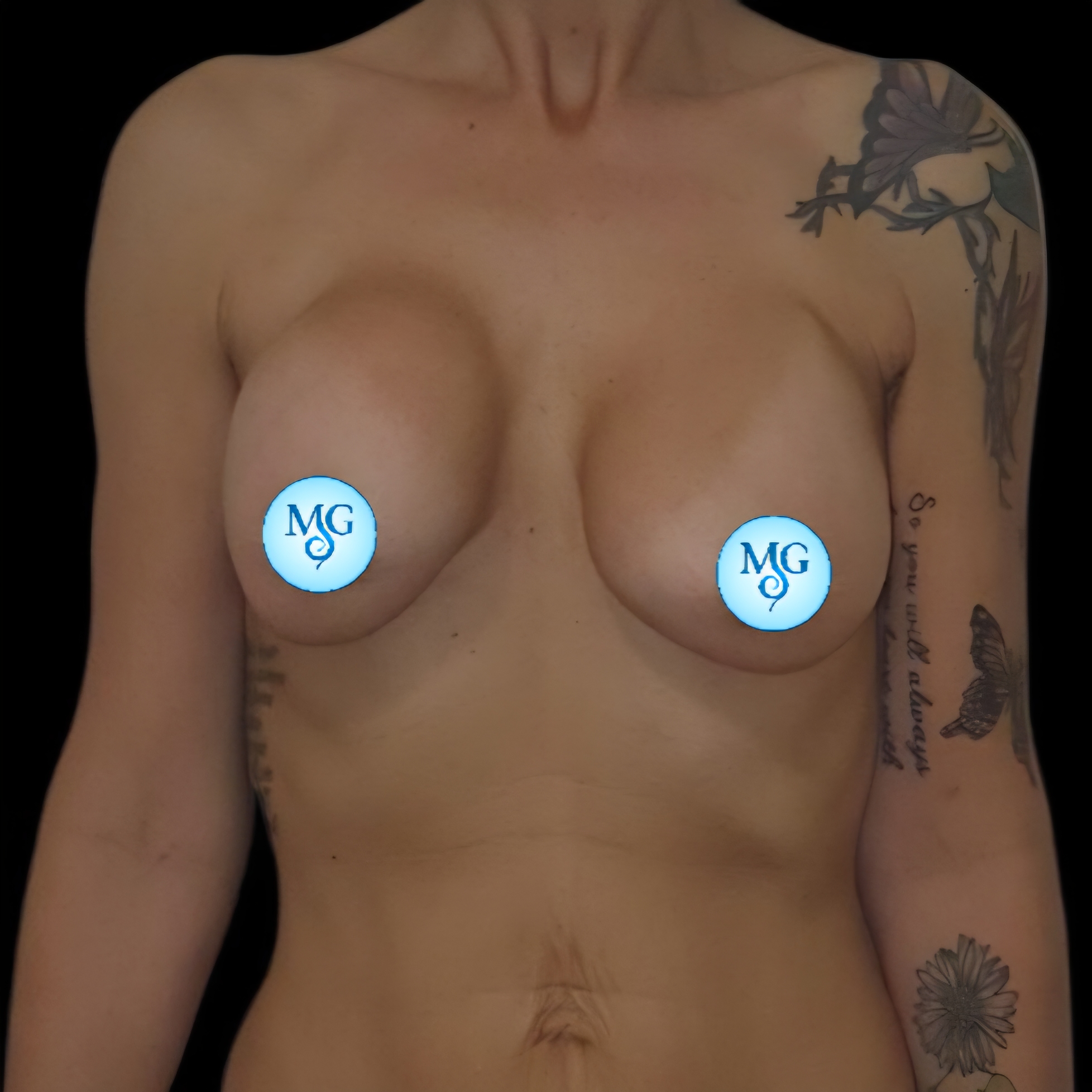 Extracción de implantes antes - caso 1, vista frontal