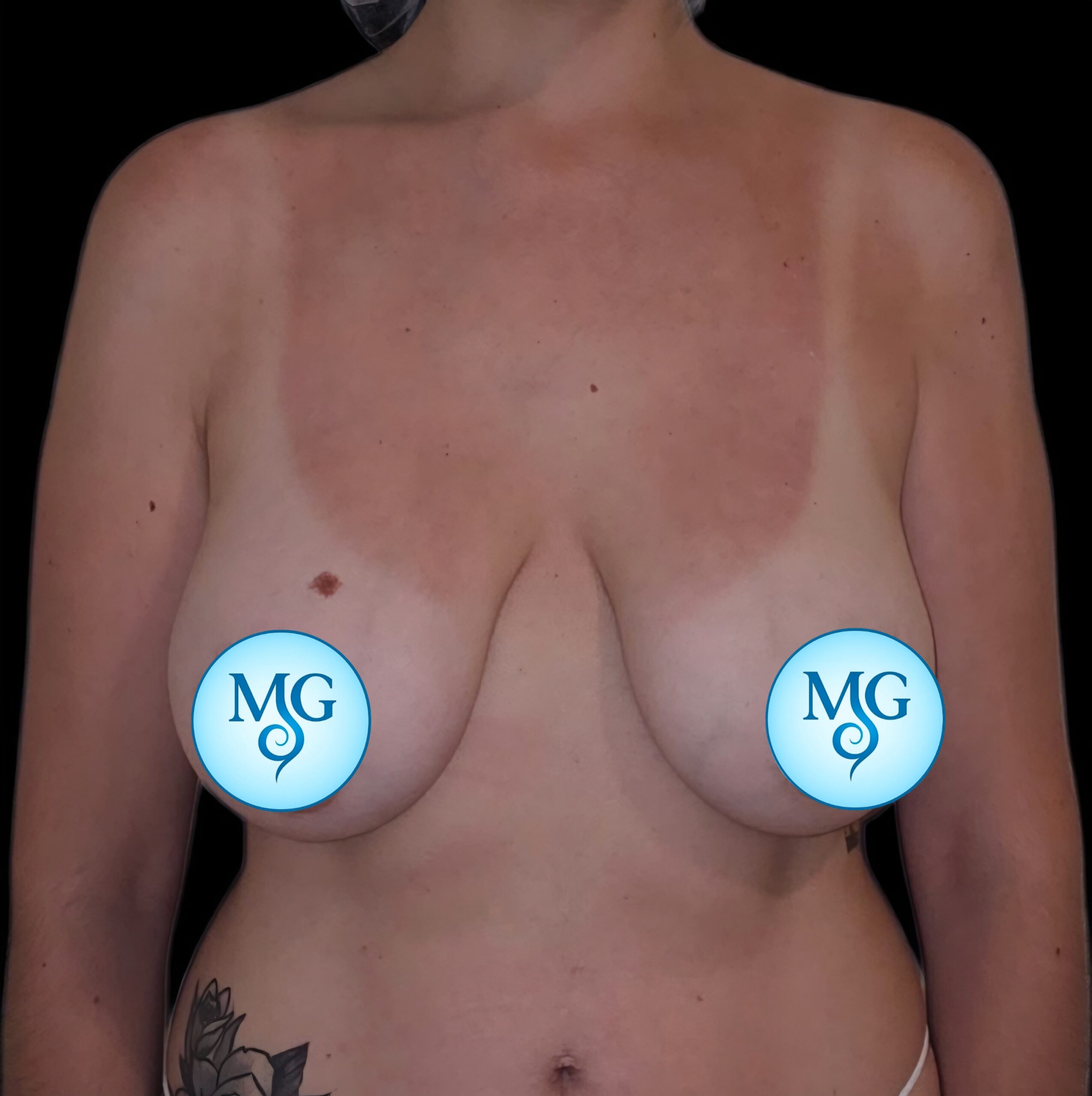 Extracción de implantes antes - caso 2, vista frontal