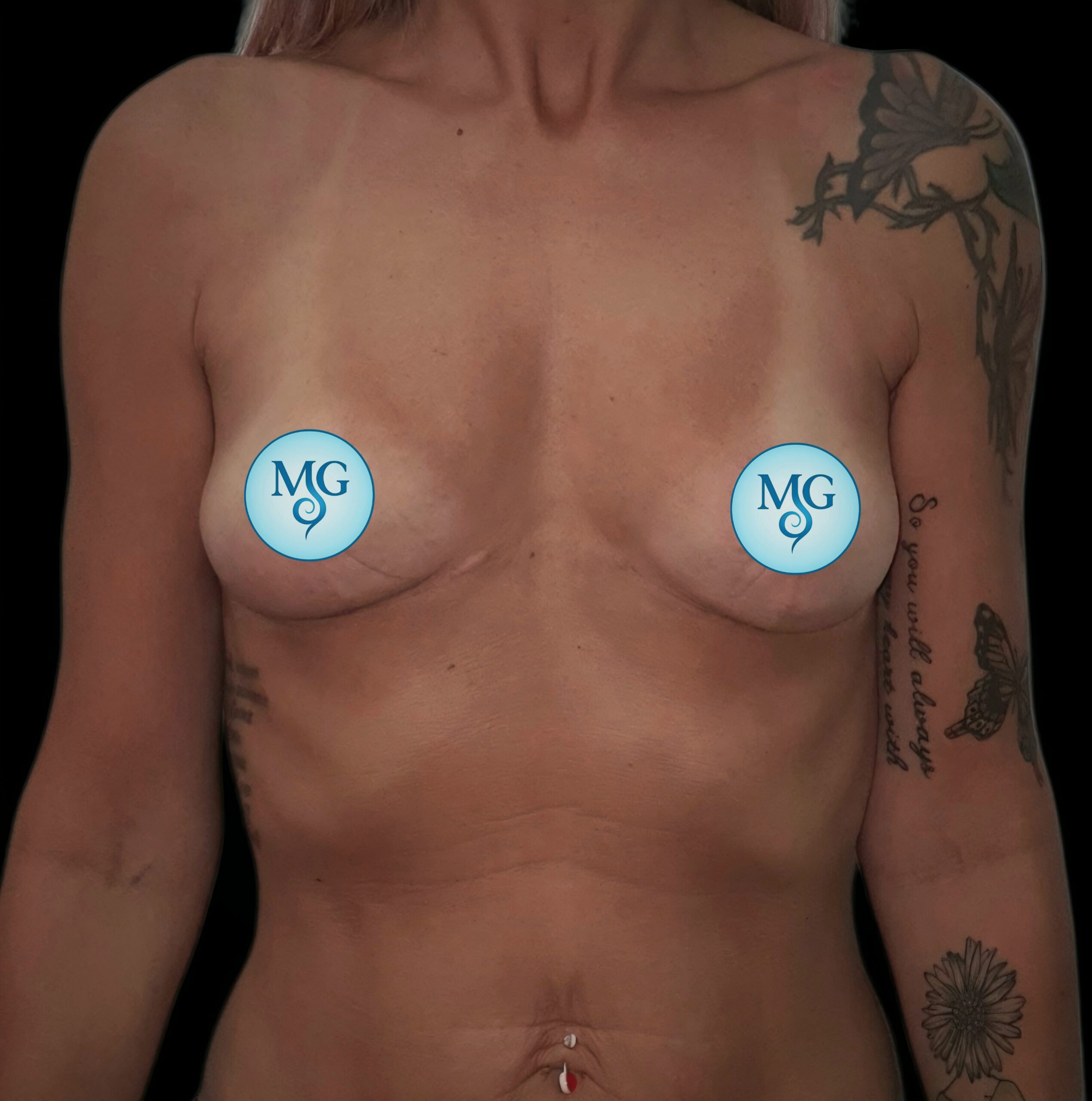 Resultado de extracción de implantes - caso 1, vista frontal