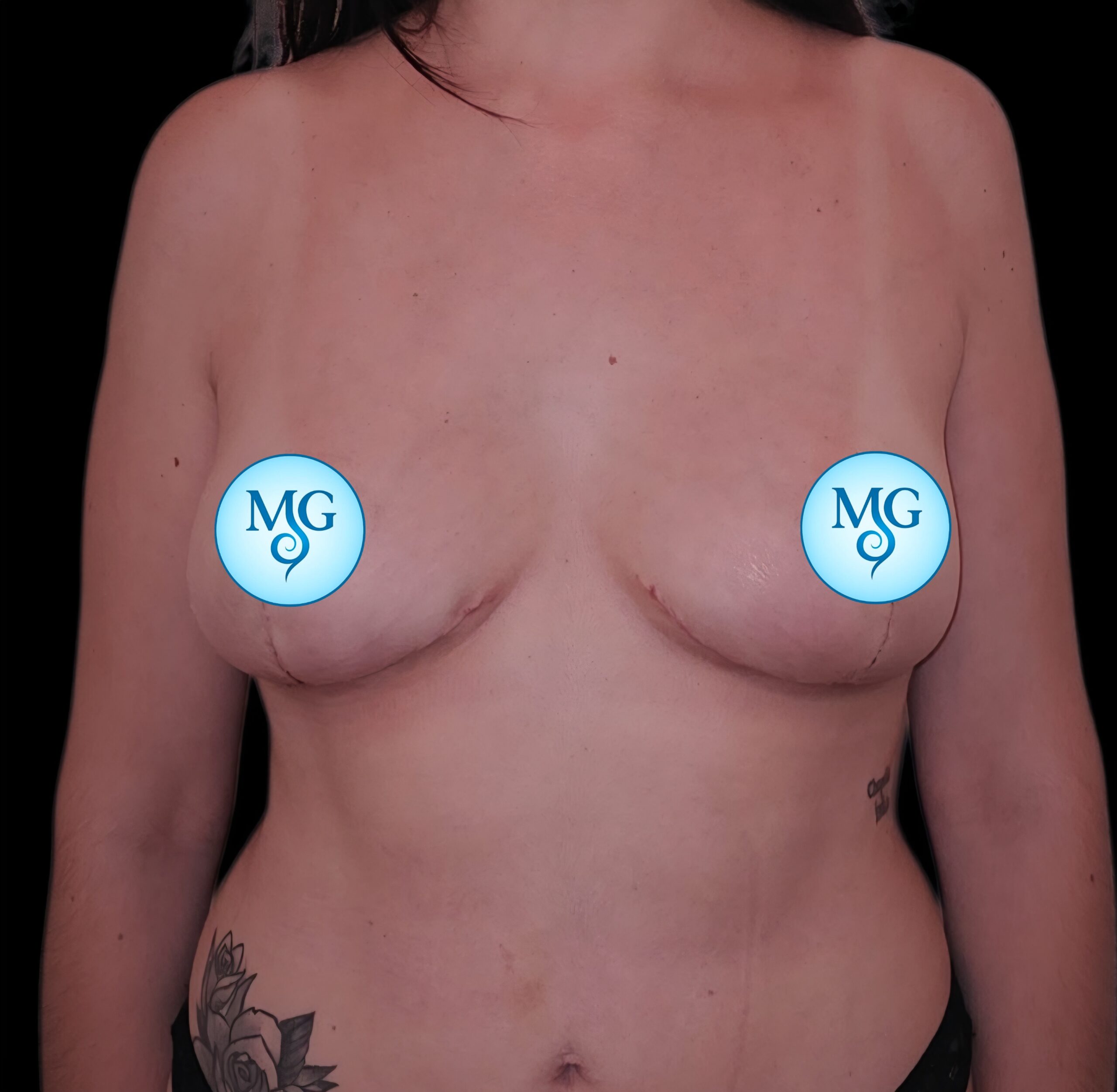 Resultado de extracción de implantes - caso 2, vista frontal
