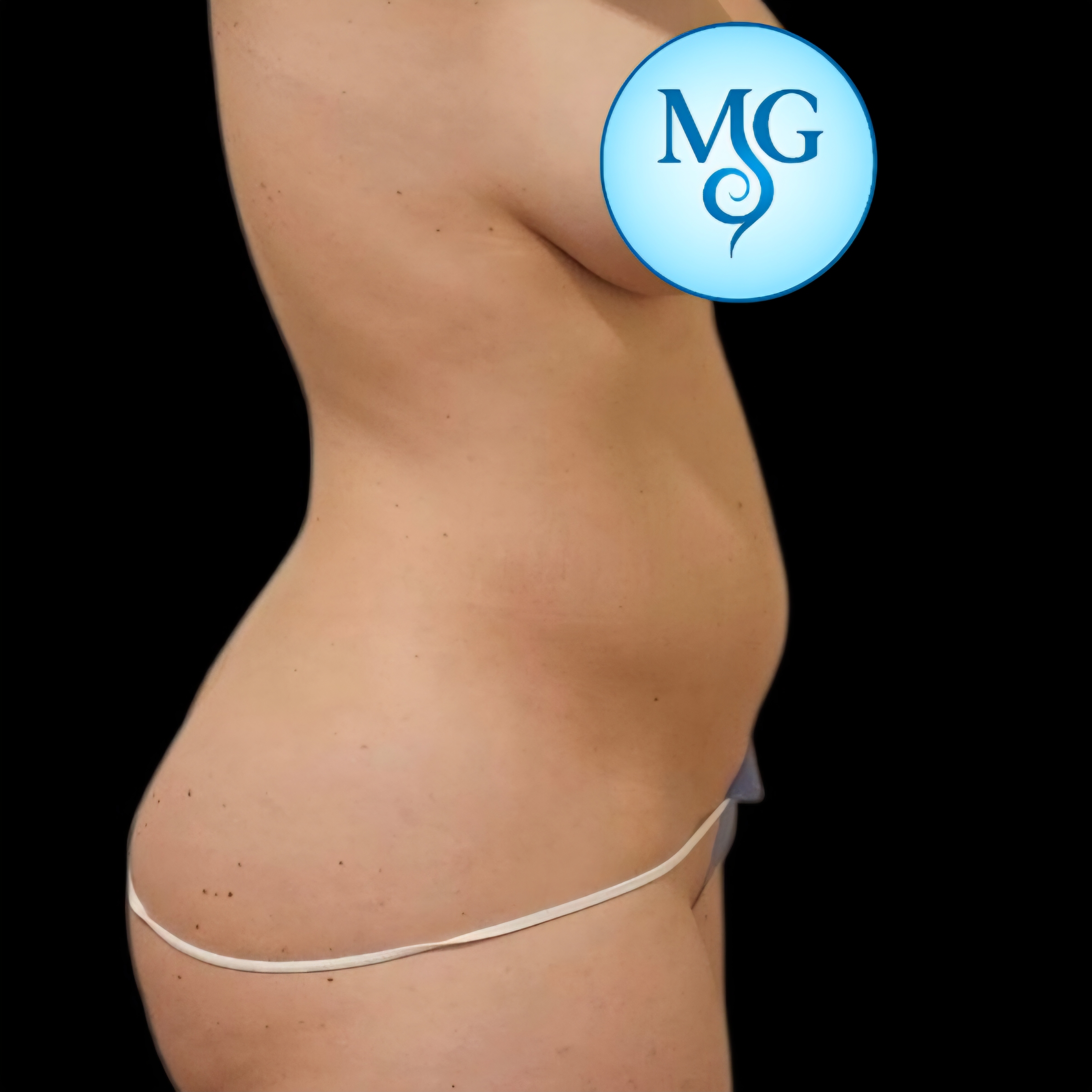 Lipoaspiración antes - caso 1, vista de perfil