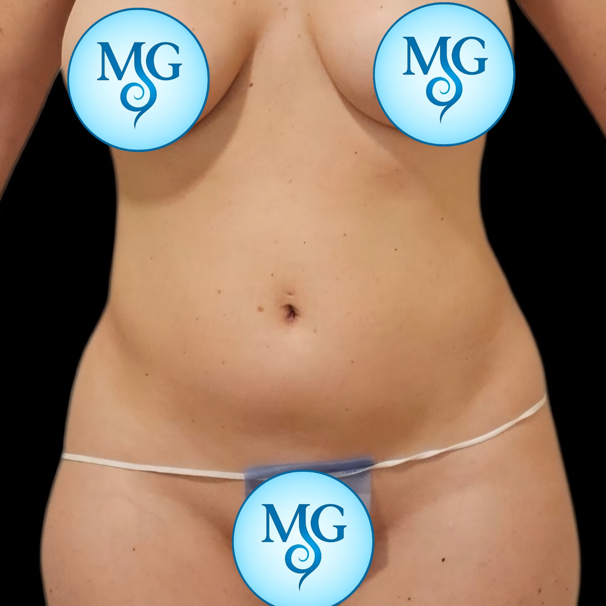 Lipoaspiración antes - caso 1, vista frontal
