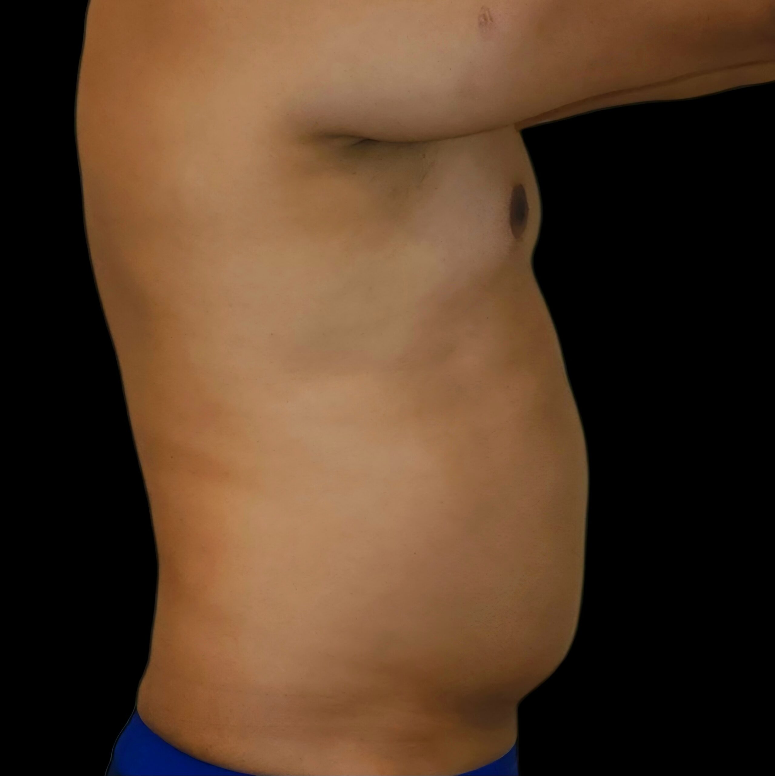 Lipoaspiración antes - caso 2, vista de perfil
