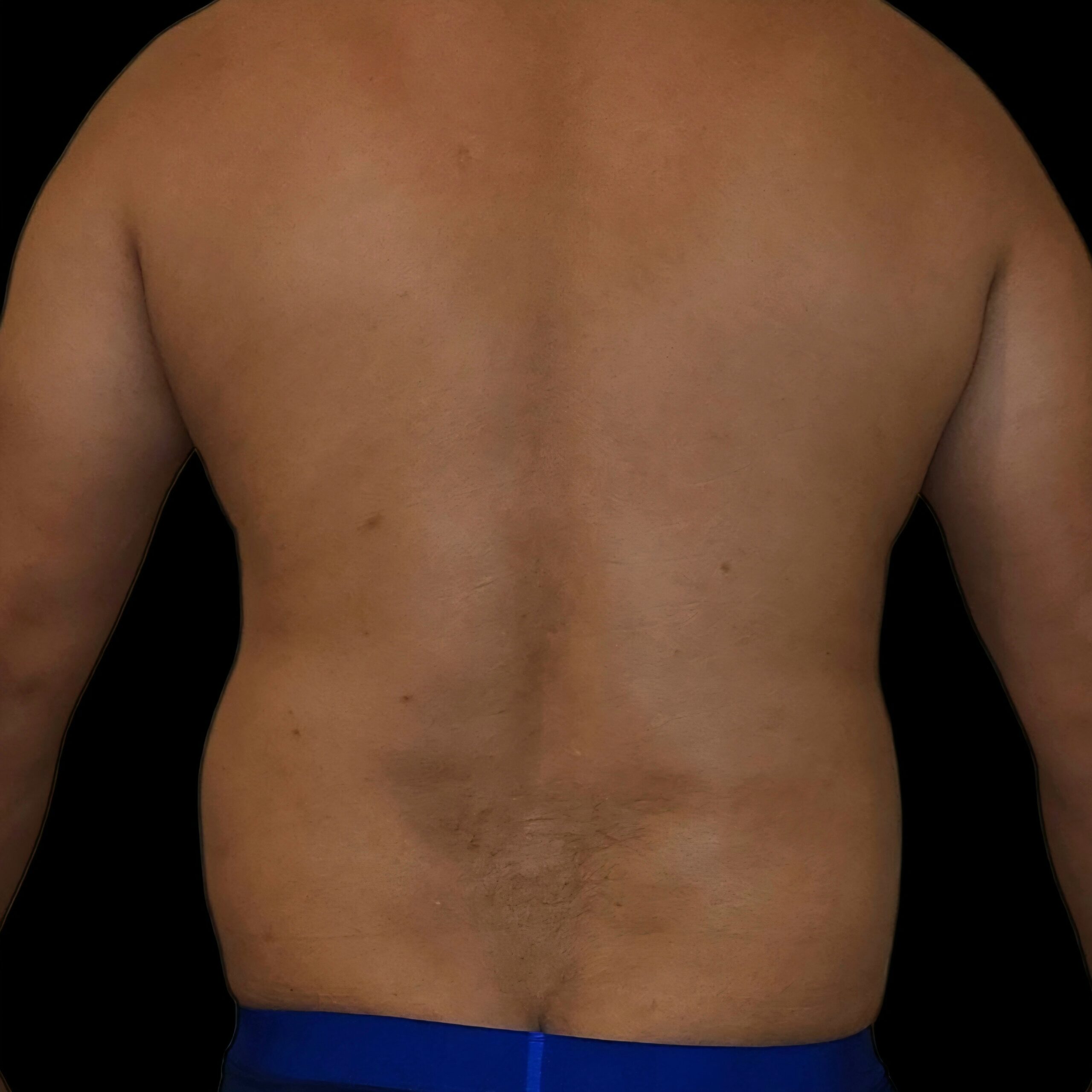Lipoaspiración antes - caso 2, vista de espalda