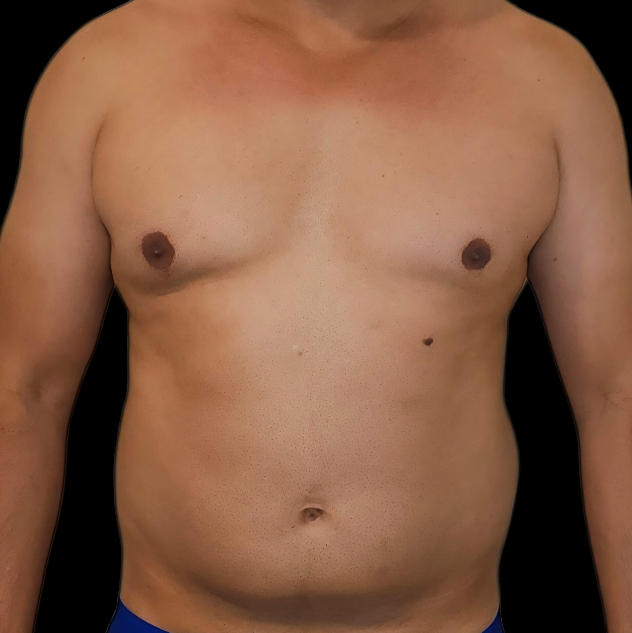 Lipoaspiración antes - caso 2, vista frontal
