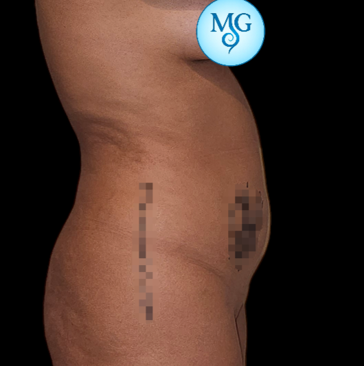Lipoaspiración antes - caso 3, vista de perfil