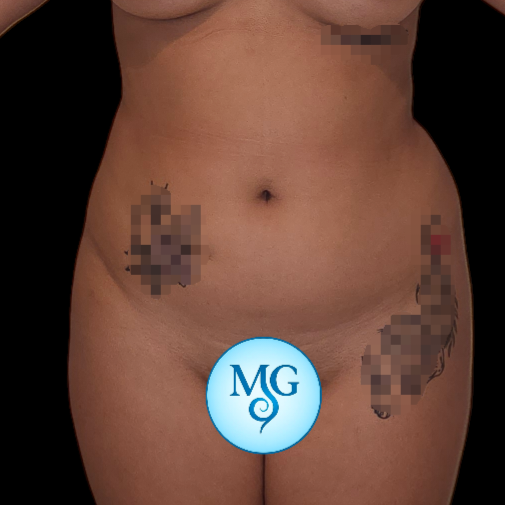 Lipoaspiración antes - caso 3, vista frontal