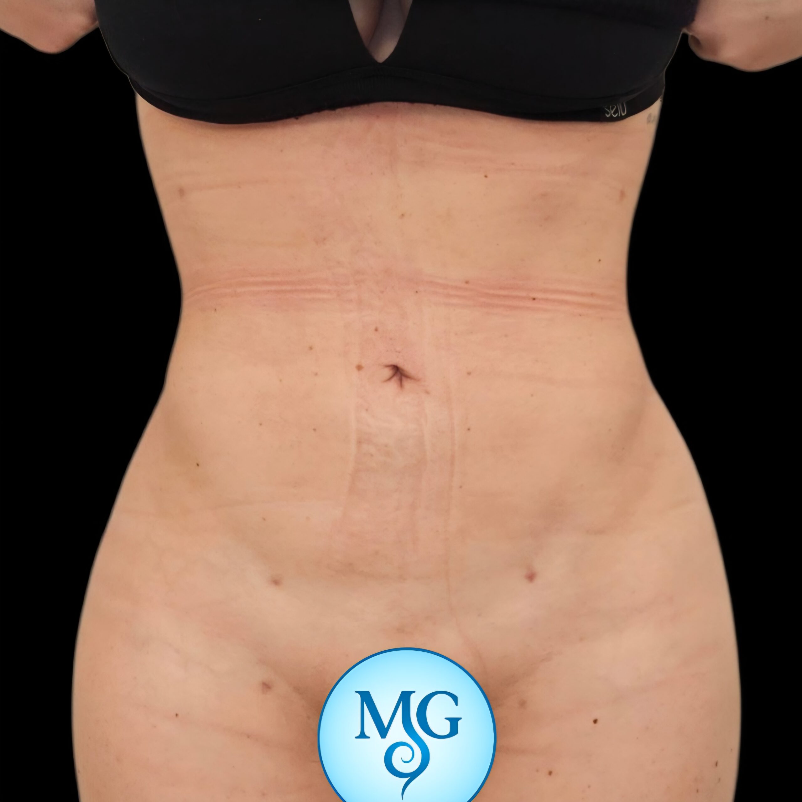 Resultado de lipoaspiración - caso 1, vista frontal