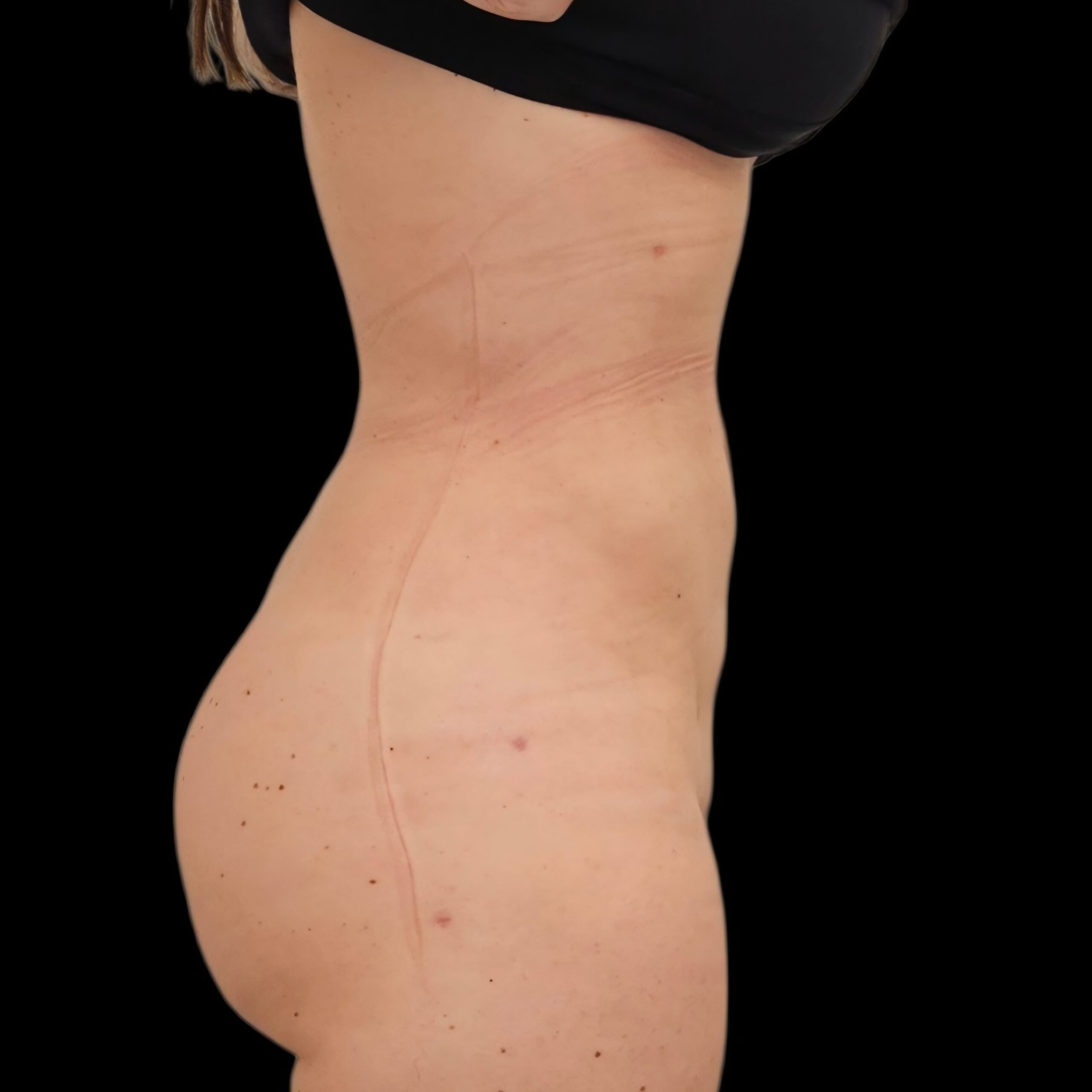 Resultado de lipoaspiración - caso 1, vista de perfil