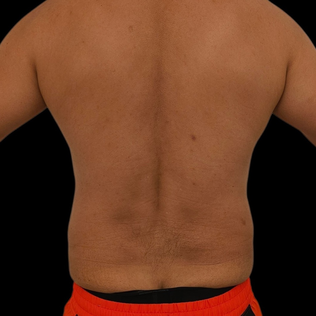Resultado de lipoaspiración - caso 2, vista de espalda