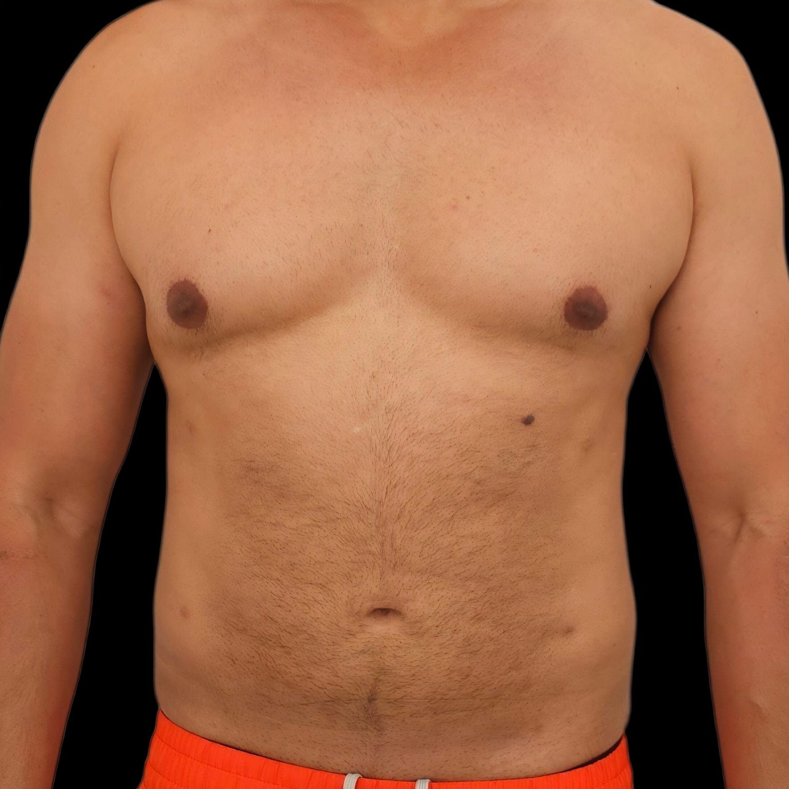 Resultado de lipoaspiración - caso 2, vista frontal