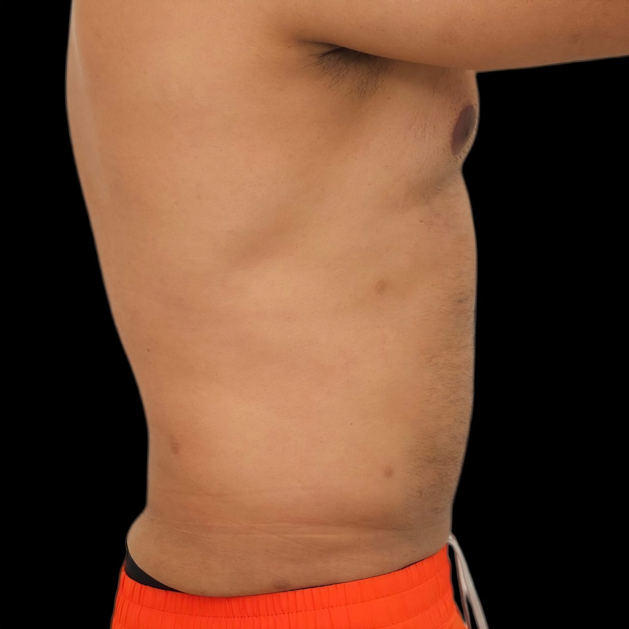 Resultado de lipoaspiración - caso 2, vista de perfil
