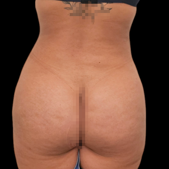 Resultado de lipoaspiración - caso 3, vista de espalda