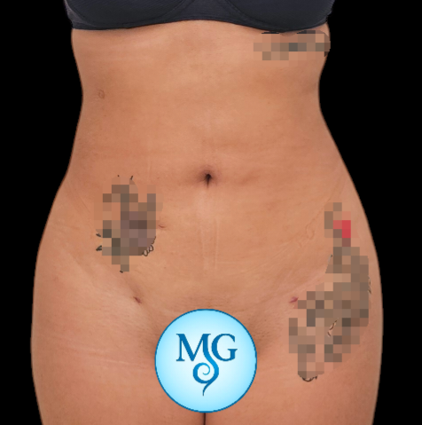 Resultado de lipoaspiración - caso 3, vista frontal