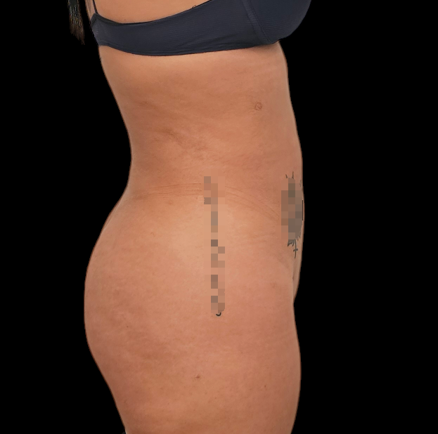Resultado de lipoaspiración - caso 3, vista de perfil