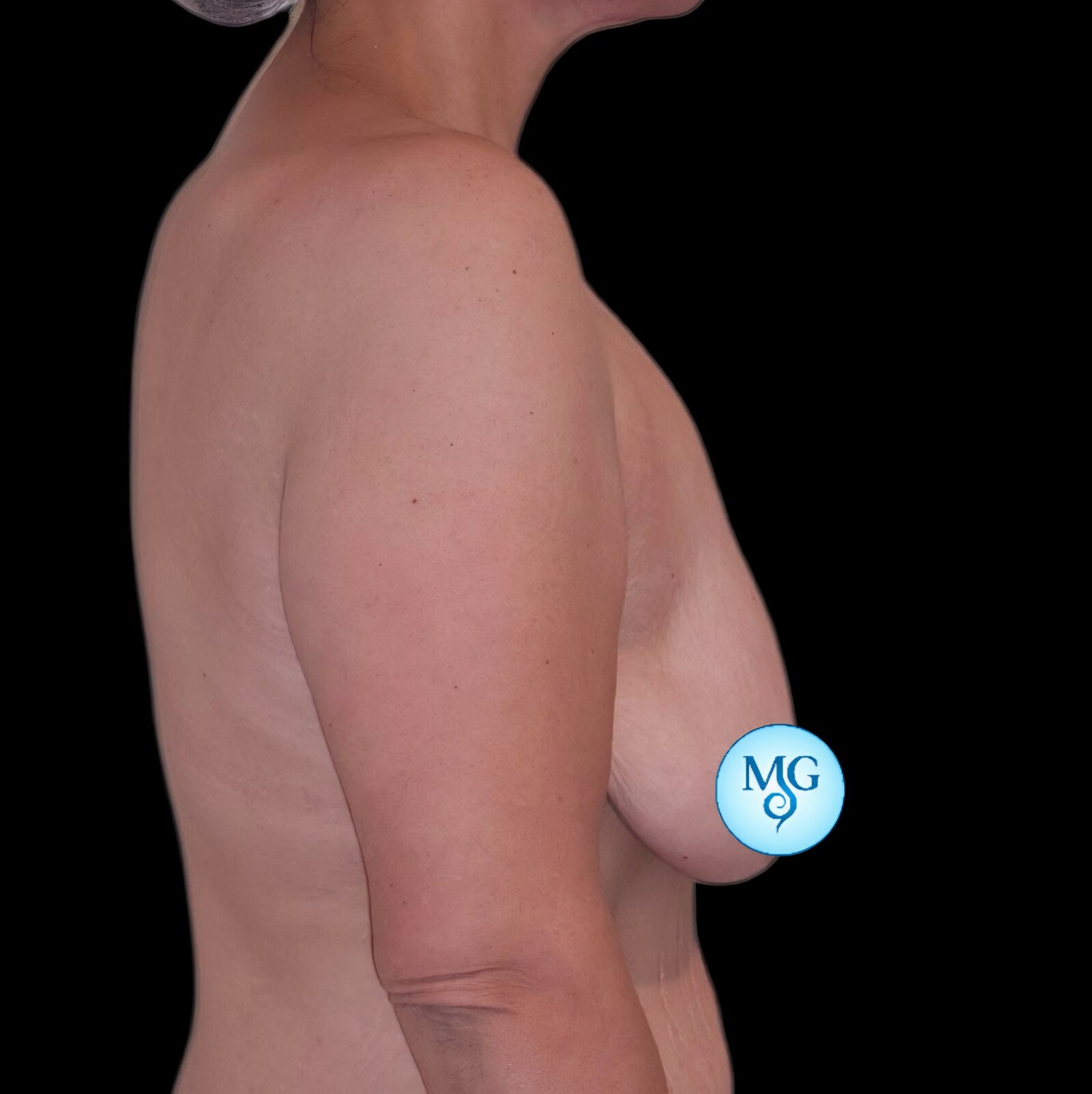 Mastopexia Antes - caso 1, perfil derecho - Dr. Gil Miranda Buenos Aires