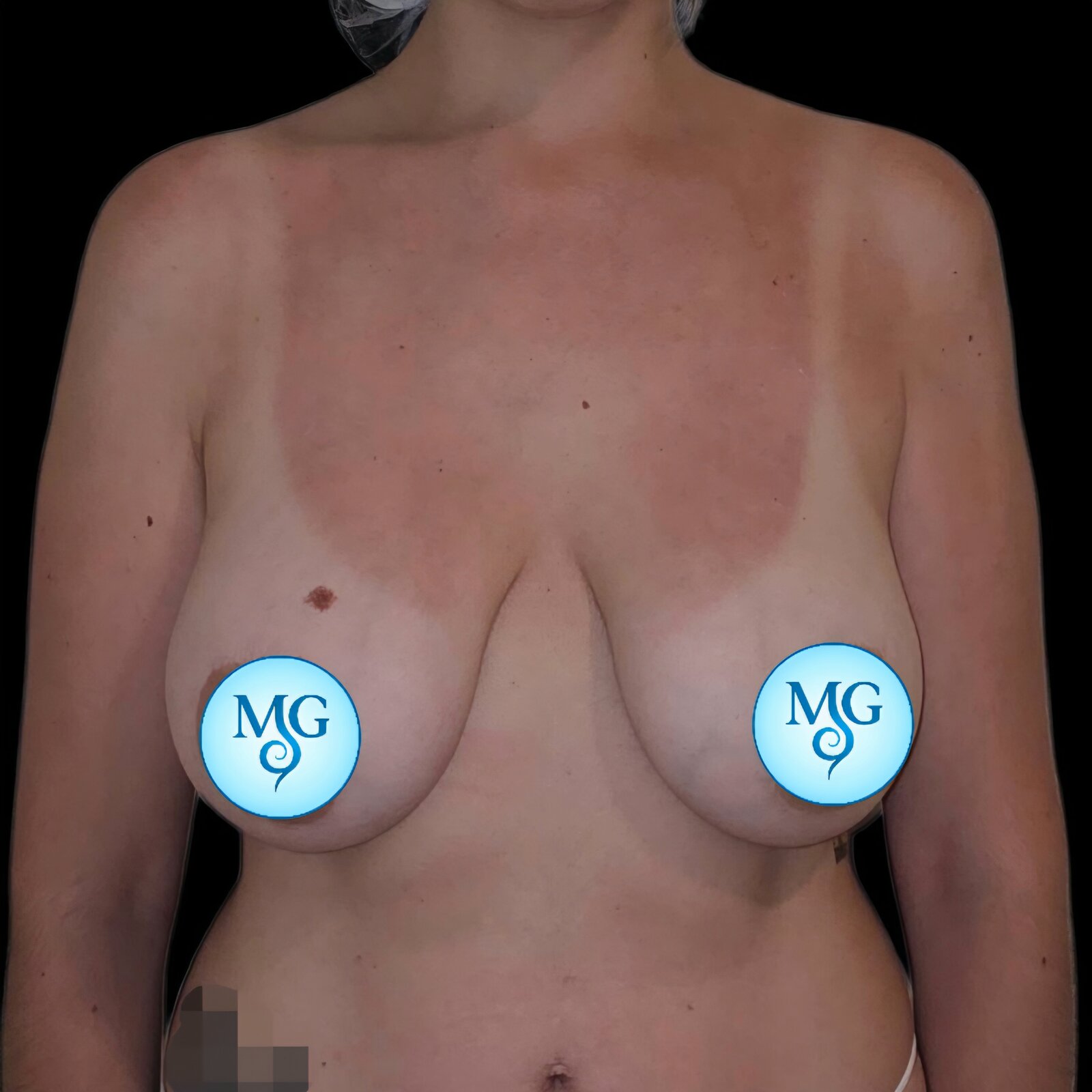 Mastopexia Antes - caso 2, vista de frente - Dr. Gil Miranda Buenos Aires