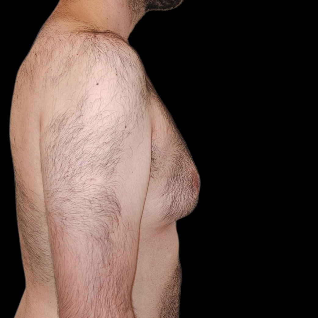 Ginecomastia antes - caso 1, perfil derecho - Dr. Gil Miranda Buenos Aires