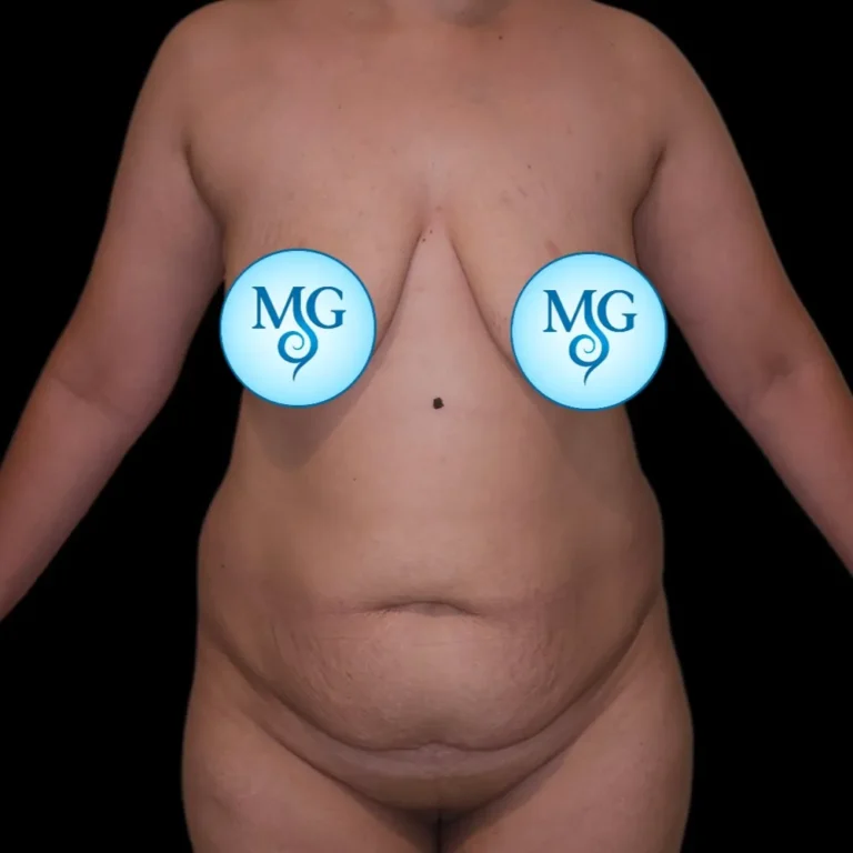 Antes de abdominoplastia, vista de frente: flacidez y exceso de piel abdominal – caso 1, Dr. Gil Miranda