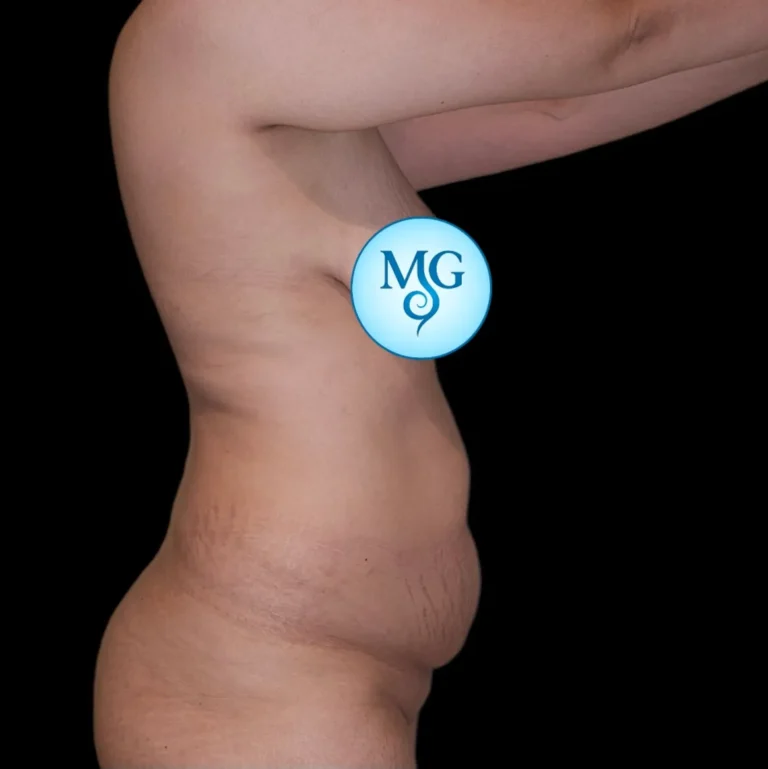 Antes de abdominoplastia, vista de perfil: flacidez y exceso de piel abdominal – caso 1, Dr. Gil Miranda
