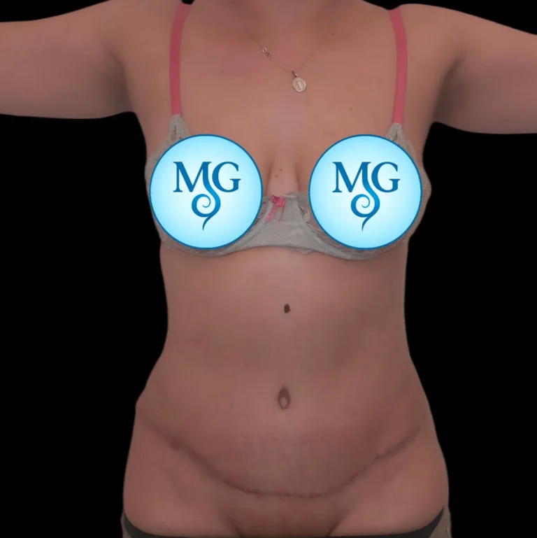 Resultado de abdominoplastia, vista de frente: abdomen más firme y cicatriz baja – caso 1, Dr. Gil Miranda