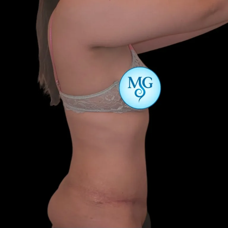 Resultado de abdominoplastia, vista de perfil: abdomen más firme y cicatriz baja – caso 1, Dr. Gil Miranda