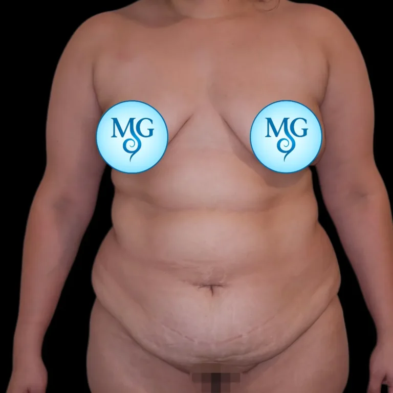 Antes de abdominoplastia, vista de frente: exceso de piel y pliegue abdominal marcado – caso 2, Dr. Gil Miranda