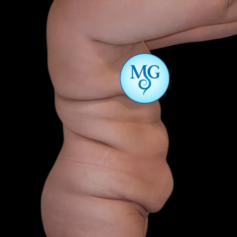 Antes de abdominoplastia, vista de perfil: exceso de piel y pliegue abdominal marcado – caso 2, Dr. Gil Miranda