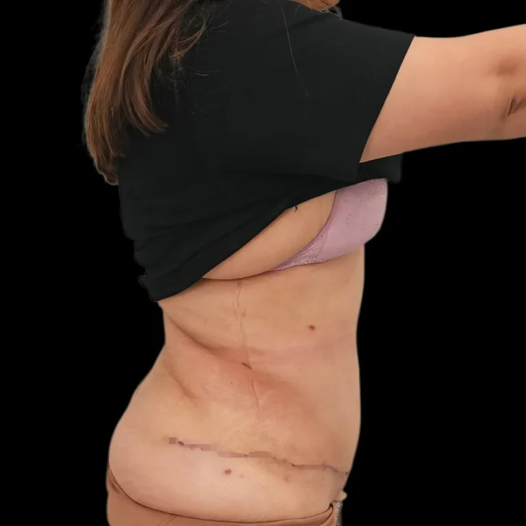 Resultado de abdominoplastia, vista de perfil: abdomen más firme y cicatriz baja – caso 2, Dr. Gil Miranda