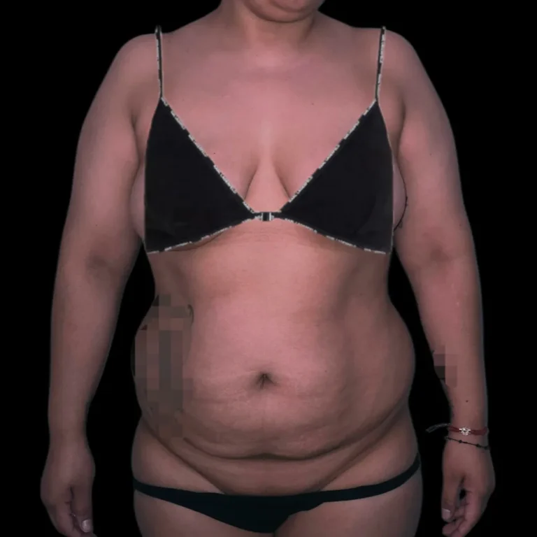 Antes de abdominoplastia, vista de frente: grasa localizada y flacidez abdominal – caso 3, Dr. Gil Miranda