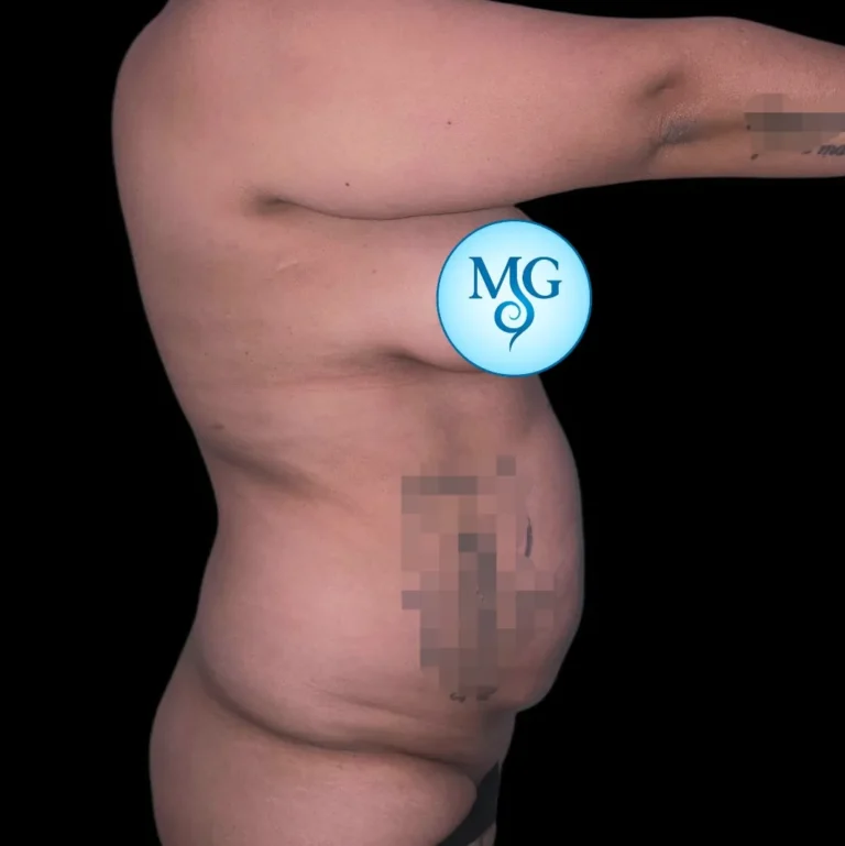 Antes de abdominoplastia, vista de perfil: grasa localizada y flacidez abdominal – caso 3, Dr. Gil Miranda