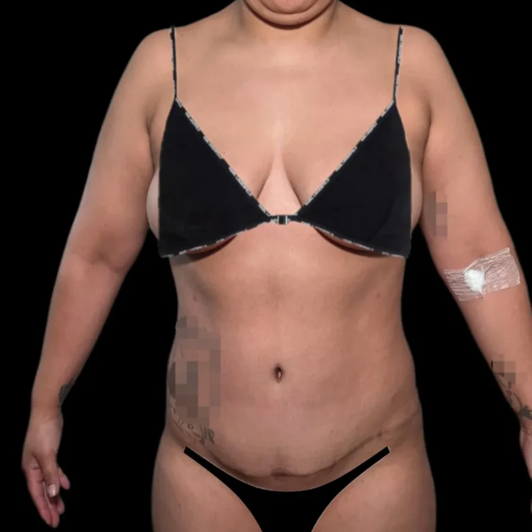 Resultado de abdominoplastia, vista de frente: abdomen más firme y cicatriz baja – caso 3, Dr. Gil Miranda