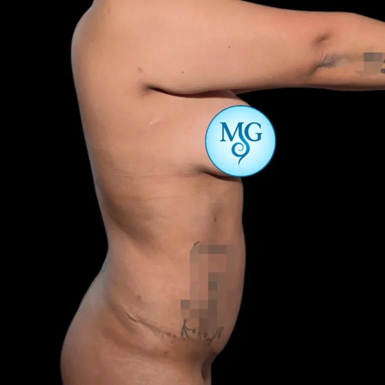 Resultado de abdominoplastia, vista de perfil: abdomen más firme y cicatriz baja – caso 3, Dr. Gil Miranda