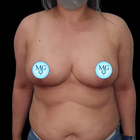 Reducción Mamaria - Resultado caso 1, vista de frente - Dr. Gil Miranda Buenos Aires